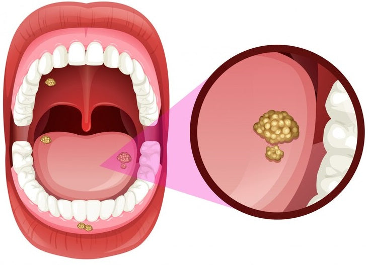 Halitosis: Understanding the Causes, Diagnosis, and Treatment for Fresh Breath