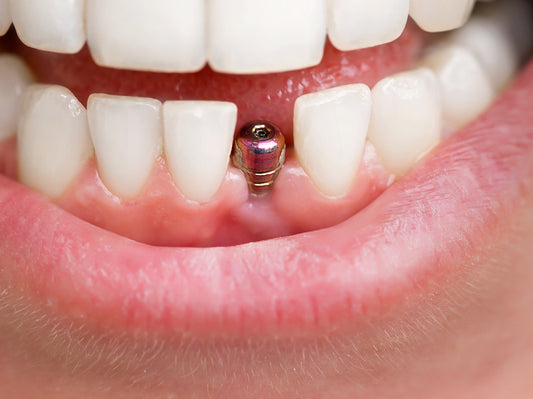 Six Indicators Your Dental Implant Is Infected