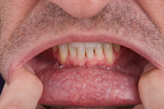 Oral Cancer Symptoms