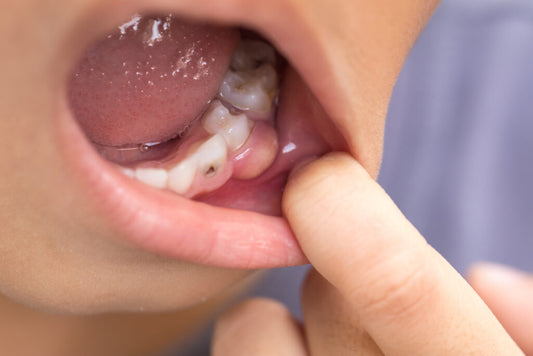 What is Dental Abscess: Signs, Causes, Remedies