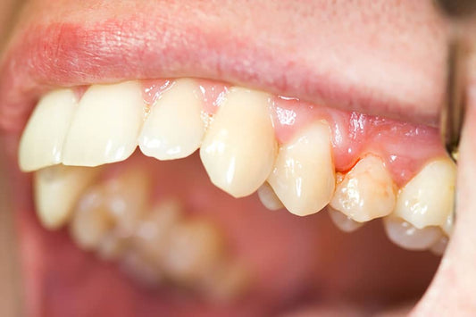 Gingivitis: Causes and Treatments